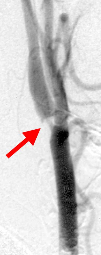 Karotisstenose Ballondilatation 1