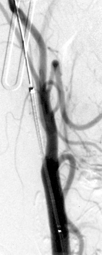 Karotisstenose Ballondilatation 2