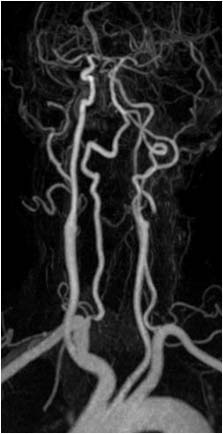 Karotisstenose Untersuchung MR