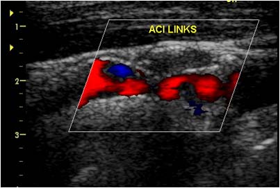 Karotisstenose Untersuchung Ultraschall