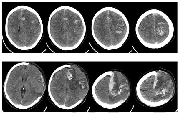 Sinusthrombose Entfernung Knochendeckel