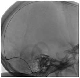 Sinusthrombose Entfernung