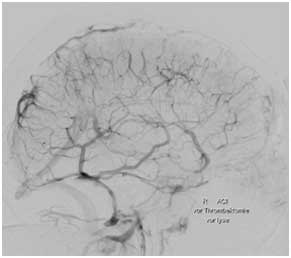 Sinusthrombose