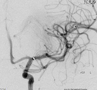 Nach Zurückziehen des Stents ist die Durchblutung wiederhergestellt