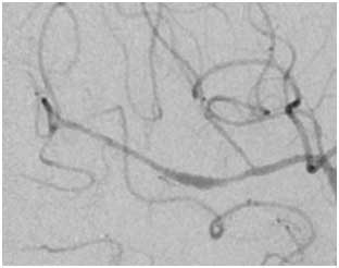 Vaskulitiden Angiographie 1