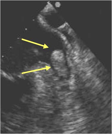 Vorhofflimmern Thromben